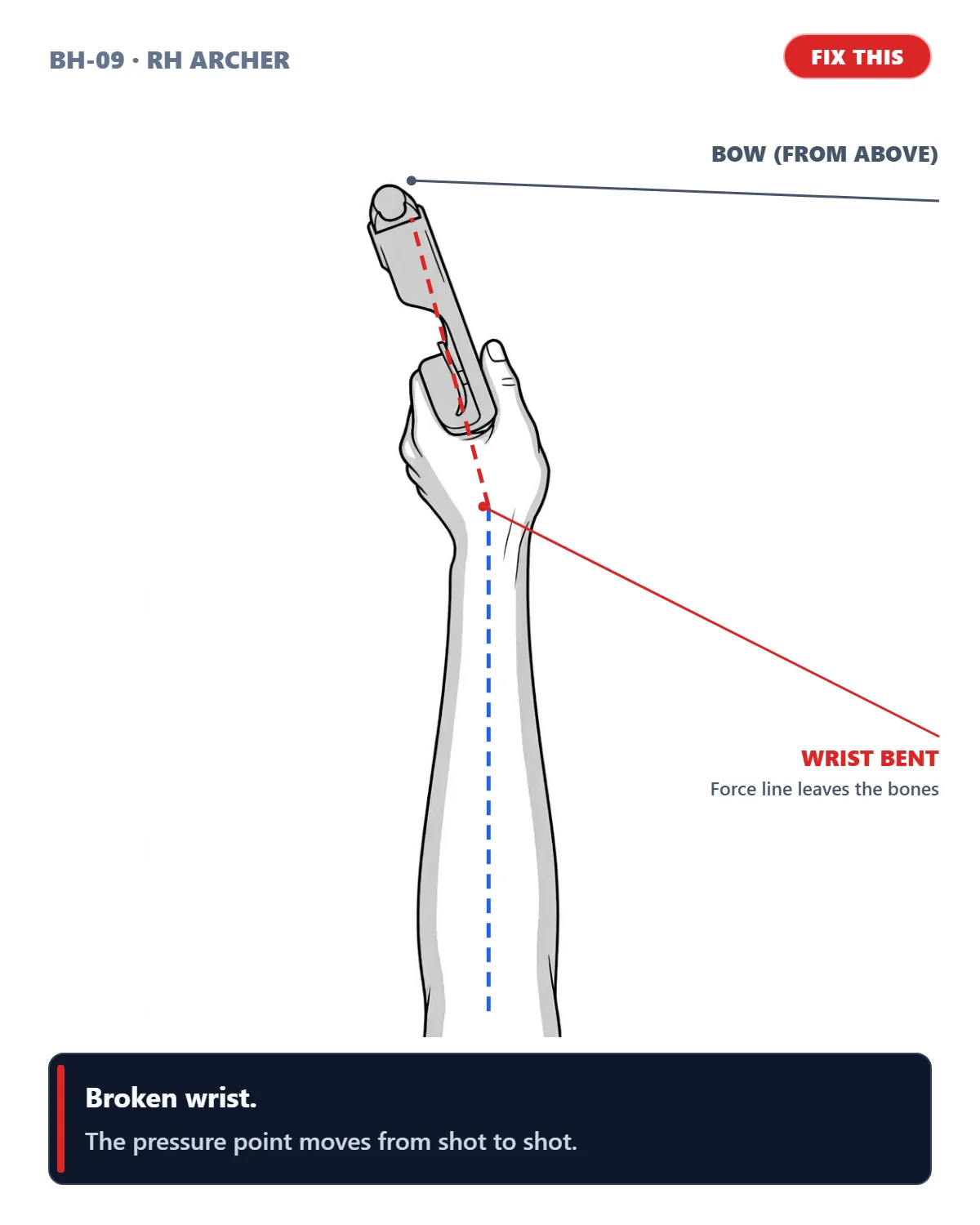 Broken Wrist (Top-Down Misalignment) (right-handed archer)